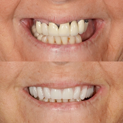 before and after look at what dental implants can do for a patient's smile